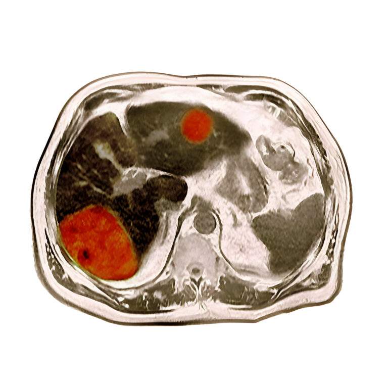 PTP1B in Hepatocellular Carcinoma